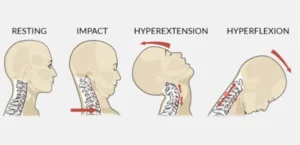 Physical Therapy for Whiplash Treatment