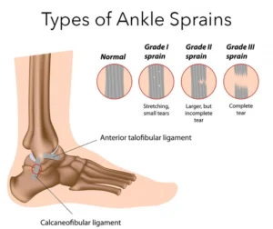 Select What To Do When You Sprain Your Ankle in the Wilderness? What To Do When You Sprain Your Ankle in the Wilderness?