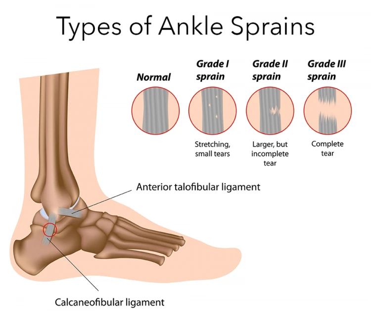 Select What To Do When You Sprain Your Ankle in the Wilderness? What To Do When You Sprain Your Ankle in the Wilderness?