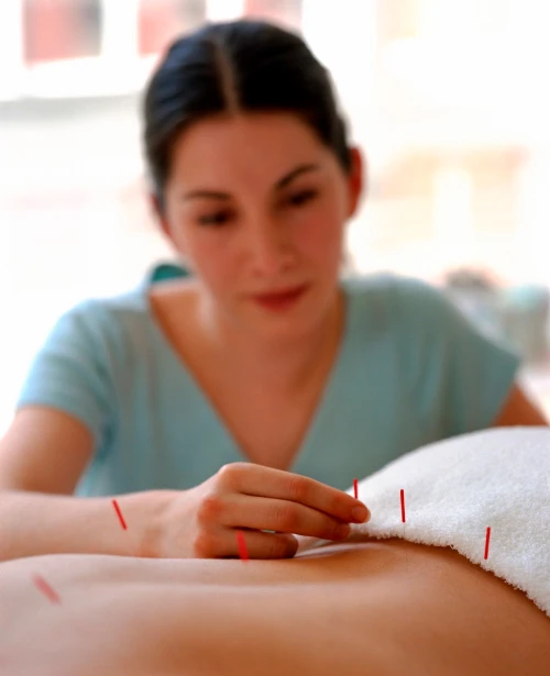 acupuncture-treatment